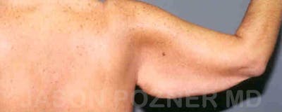 Brachioplasty Before & After Gallery - Patient 17932086 - Image 1