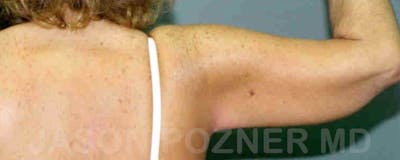 Brachioplasty Before & After Gallery - Patient 17932086 - Image 2