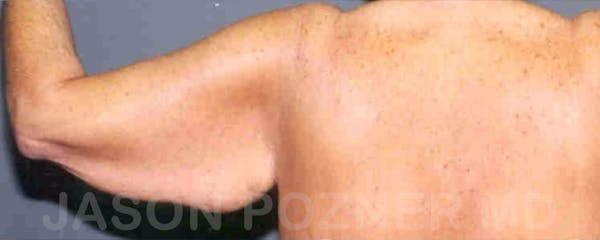 Brachioplasty Before & After Gallery - Patient 17932086 - Image 3