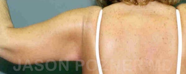 Brachioplasty Before & After Gallery - Patient 17932086 - Image 4