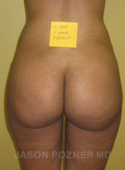 Butt Augmentation Before & After Gallery - Patient 17932087 - Image 2