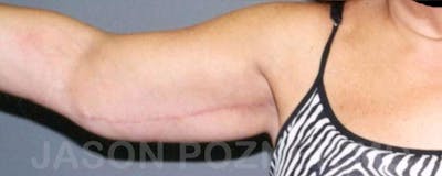 Brachioplasty Before & After Gallery - Patient 17932092 - Image 2