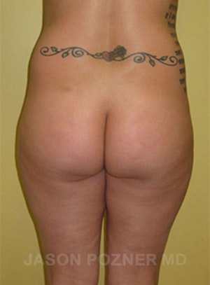 Buttock Augmentation