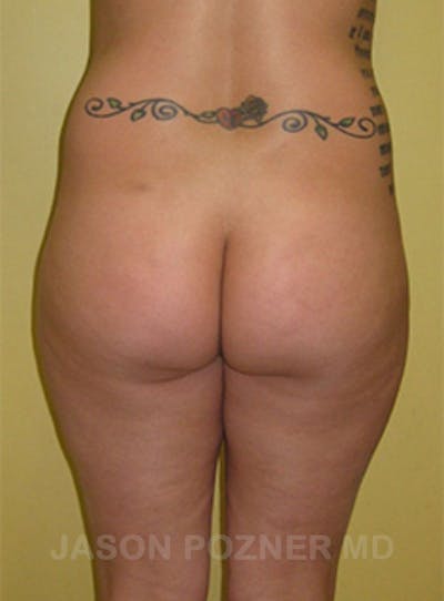 Buttock Augmentation Before & After Gallery - Patient 17932093 - Image 1