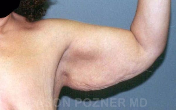 Brachioplasty Before & After Gallery - Patient 17932092 - Image 3