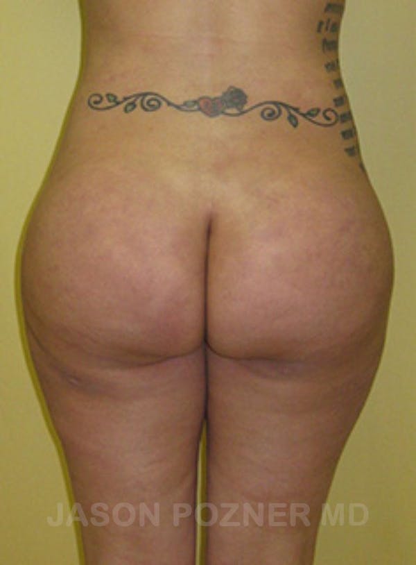 Butt Augmentation Before & After Gallery - Patient 17932093 - Image 2