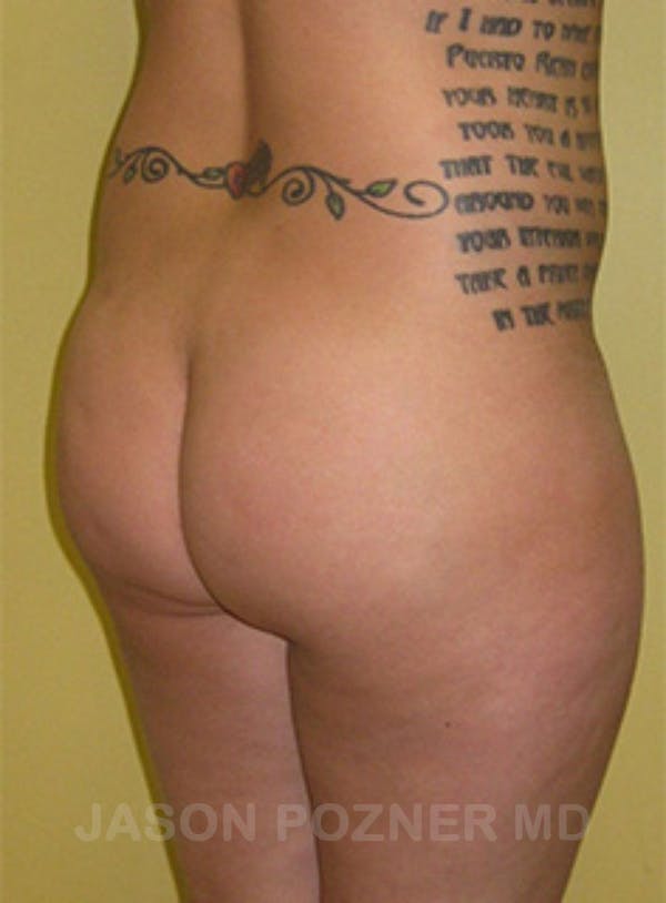 Buttock Augmentation Before & After Gallery - Patient 17932093 - Image 3