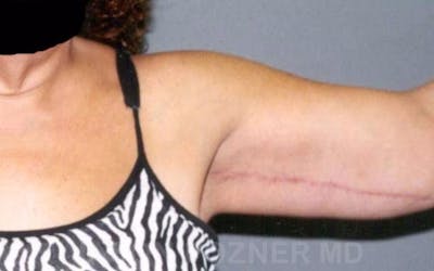 Brachioplasty Before & After Gallery - Patient 17932092 - Image 4