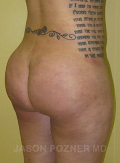 Buttock Augmentation Before & After Gallery - Patient 17932093 - Image 4