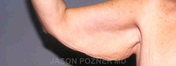 Brachioplasty Before & After Gallery - Patient 17932100 - Image 3