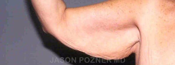 Brachioplasty Before & After Gallery - Patient 17932100 - Image 3