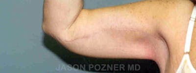 Brachioplasty Before & After Gallery - Patient 17932100 - Image 4