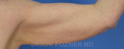 Brachioplasty Before & After Gallery - Patient 17932102 - Image 1