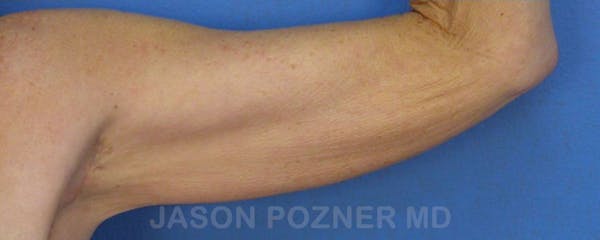Brachioplasty Before & After Gallery - Patient 17932102 - Image 2