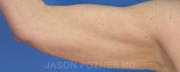 Brachioplasty Before & After Gallery - Patient 17932102 - Image 3