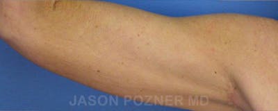 Brachioplasty Before & After Gallery - Patient 17932102 - Image 4