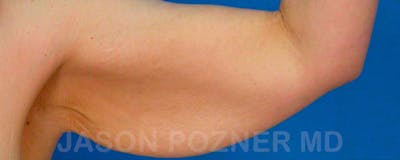 Brachioplasty Before & After Gallery - Patient 17932107 - Image 1