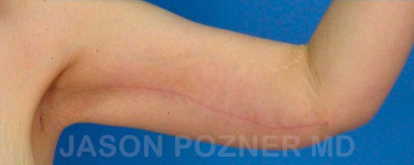Brachioplasty Before & After Gallery - Patient 17932107 - Image 2