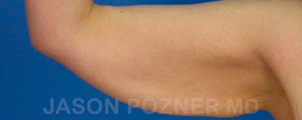 Brachioplasty Before & After Gallery - Patient 17932107 - Image 3