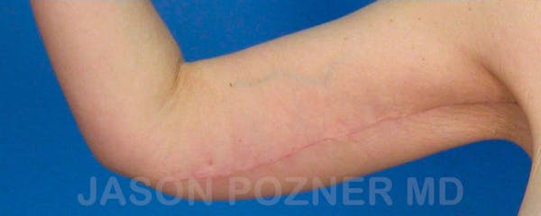 Brachioplasty Before & After Gallery - Patient 17932107 - Image 4