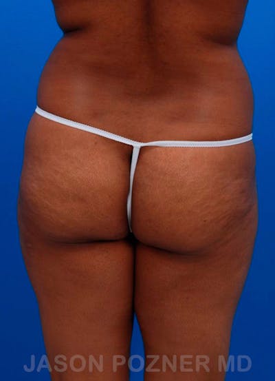 BodyTite & Renuvion Before & After Gallery - Patient 17932112 - Image 1