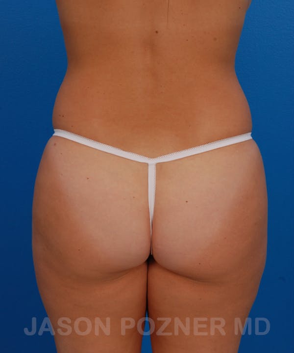 Liposuction Before & After Gallery - Patient 19056940 - Image 1