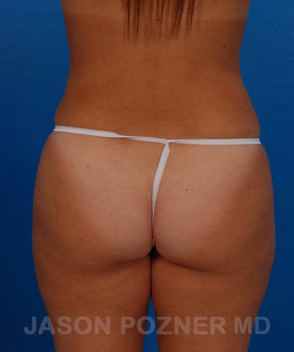 Liposuction Before & After Gallery - Patient 19056940 - Image 2