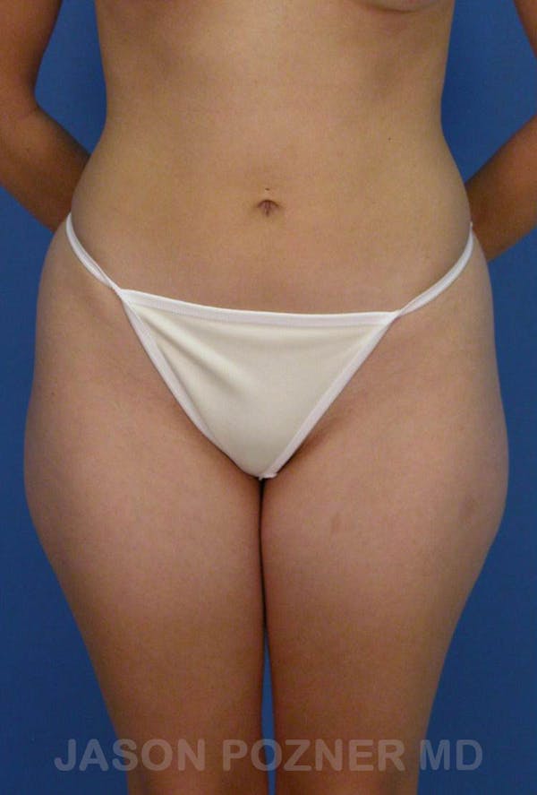 Liposuction Gallery - Patient 19056941 - Image 1