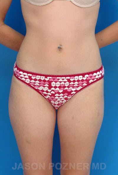 Liposuction Before & After Gallery - Patient 19056941 - Image 2