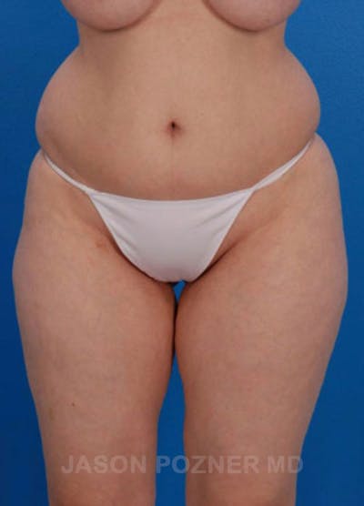 Liposuction Before & After Gallery - Patient 19056943 - Image 1