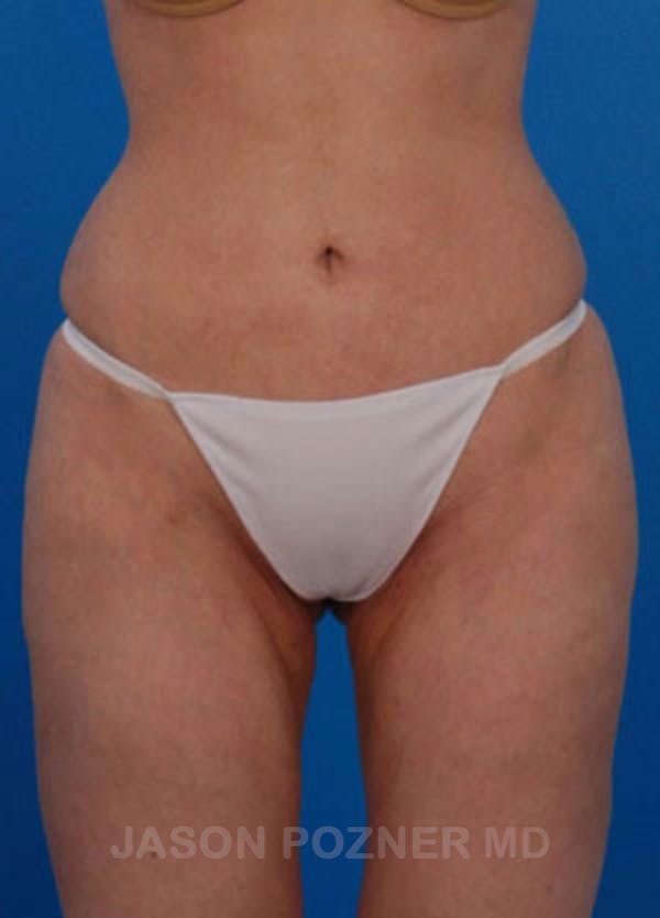 Liposuction Before & After Gallery - Patient 19056943 - Image 2