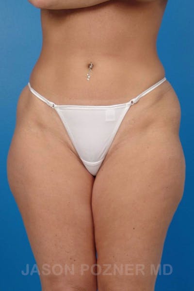 Liposuction Before & After Gallery - Patient 19056945 - Image 1