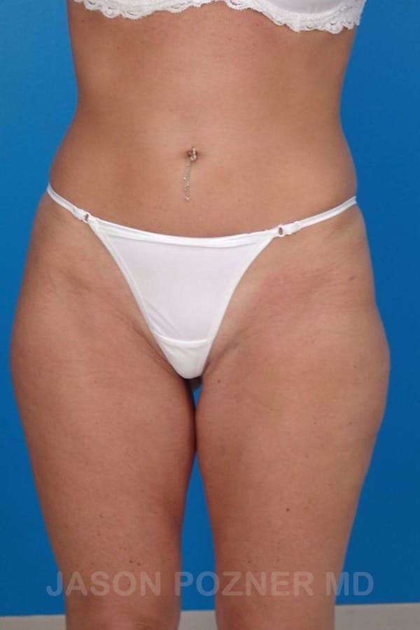 Liposuction Gallery - Patient 19056945 - Image 2