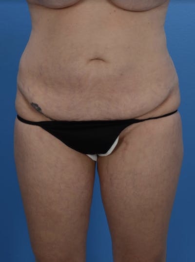 Tummy Tuck Before & After Gallery - Patient 24079558 - Image 1