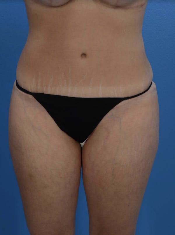Tummy Tuck Before & After Gallery - Patient 24079558 - Image 2