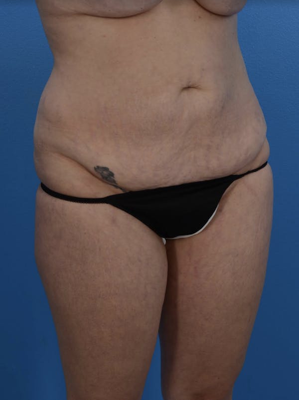 Tummy Tuck Before & After Gallery - Patient 24079558 - Image 3