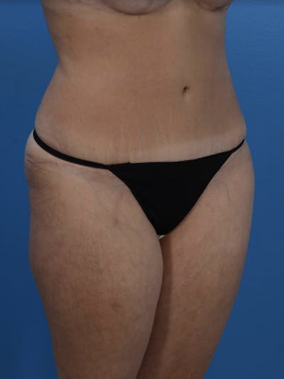 Tummy Tuck Before & After Gallery - Patient 24079558 - Image 4