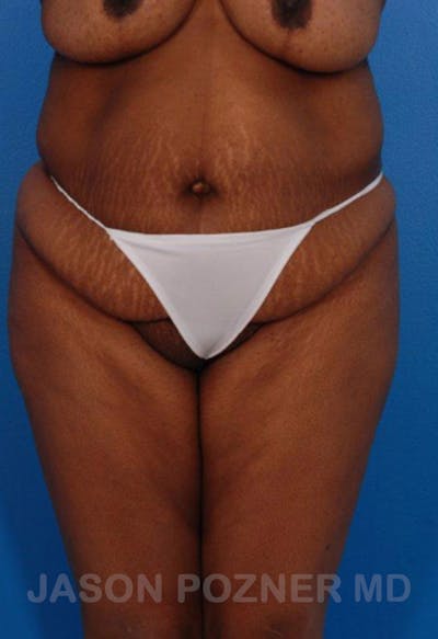 Liposuction Before & After Gallery - Patient 19057017 - Image 1