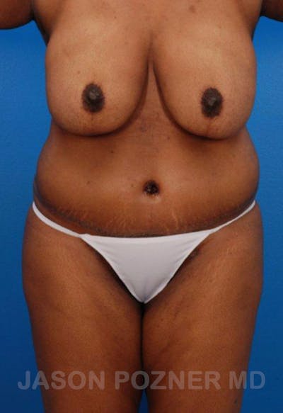 Liposuction Before & After Gallery - Patient 19057017 - Image 2