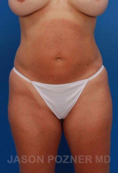 Liposuction Before & After Gallery - Patient 19057019 - Image 1