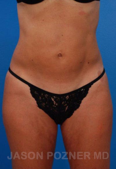 Liposuction Before & After Gallery - Patient 19057019 - Image 2