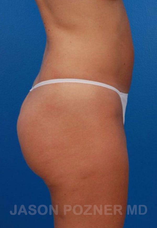 Liposuction Before & After Gallery - Patient 19057019 - Image 3