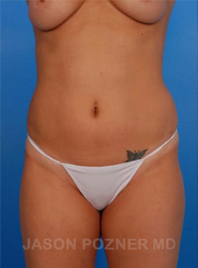 VASERlipo®  Before & After Gallery - Patient 19057048 - Image 1