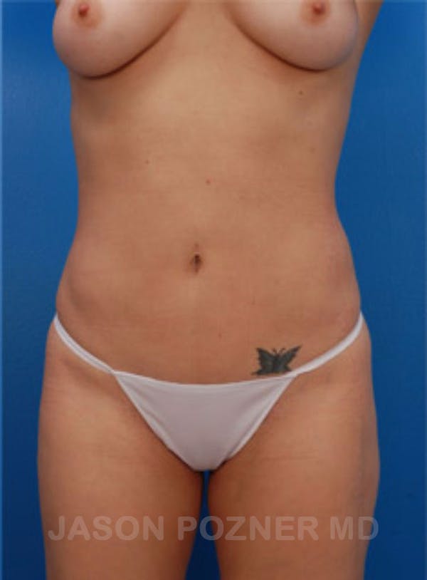 VASERlipo®  Before & After Gallery - Patient 19057048 - Image 2