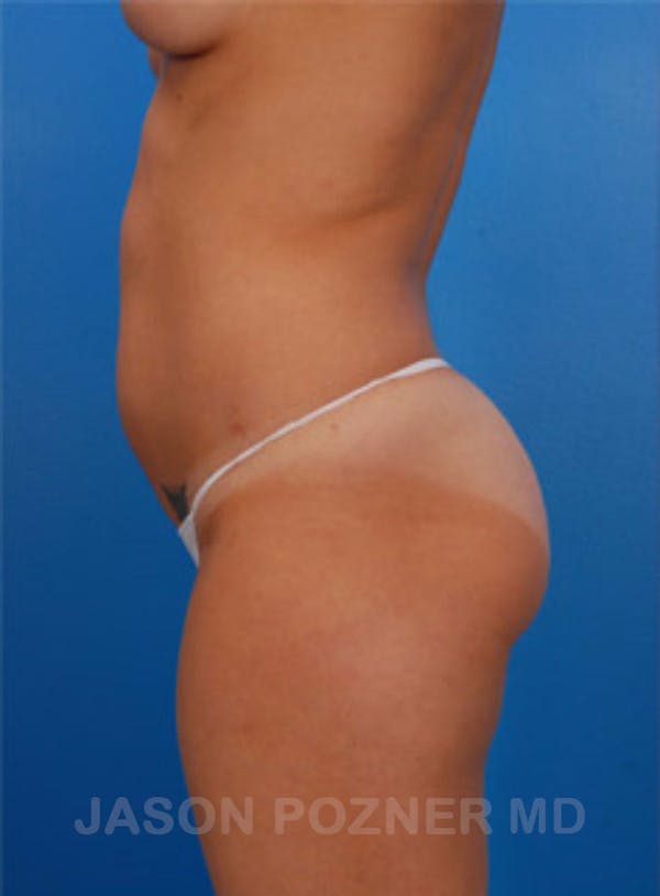 VASERlipo®  Before & After Gallery - Patient 19057048 - Image 3