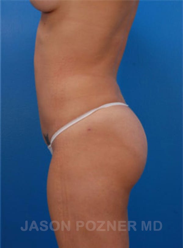 VASERlipo®  Before & After Gallery - Patient 19057048 - Image 4