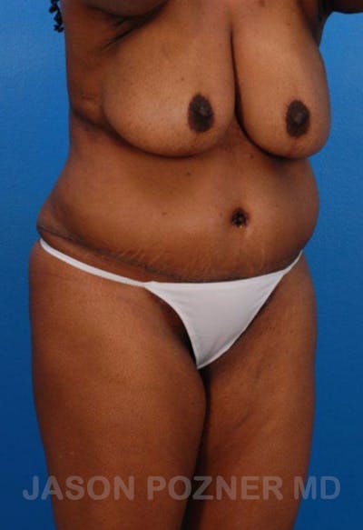 VASERlipo®  Before & After Gallery - Patient 19057049 - Image 4