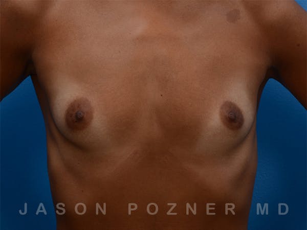 Breast Augmentation Before & After Gallery - Patient 19057061 - Image 1