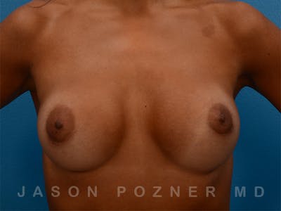 Breast Augmentation Before & After Gallery - Patient 19057061 - Image 2