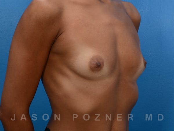 Breast Augmentation Before & After Gallery - Patient 19057061 - Image 3